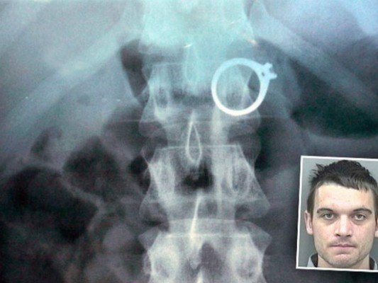 Las 10 cosas más extrañas halladas en el estómago de una persona