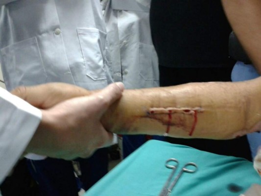 Realizarán brigada para pacientes que requieren cirugía de manos