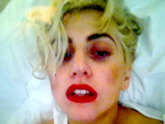 Caída de Lady Gaga en Nueva Zelanda tuvo consecuencias