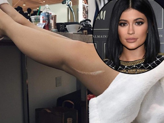 La gran cicatriz de Kylie Jenner