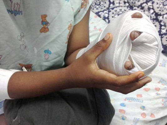 Tres niños más se queman por mal uso de pólvora; cifra de víctimas sube a 71