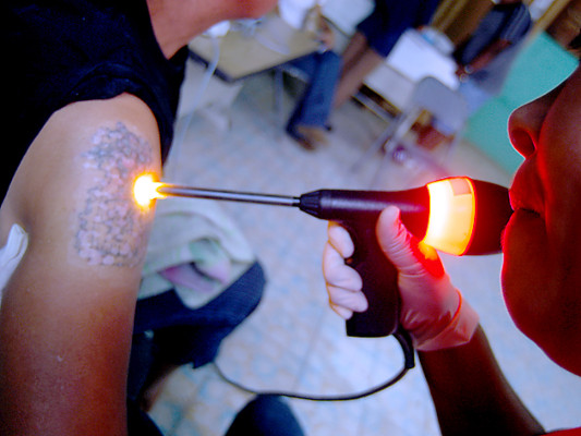 Más de 3,000 expandilleros hondureños han borrado tatuajes de sus cuerpos