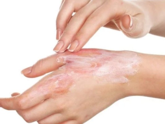 6 remedios para quemaduras con plancha