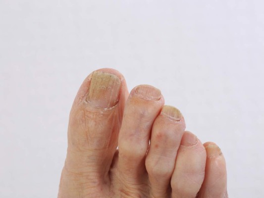 ¿Cómo eliminar los hongos de los pies con dos remedios caseros?