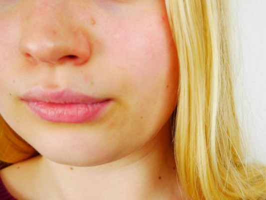 El 'triángulo de la muerte' de tu cara que puede ser fatal si lo tocas