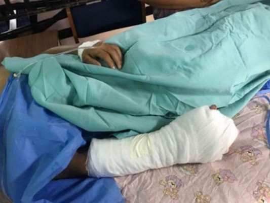 Dos hombres quemados por pólvora ingresan al IHSS en Navidad