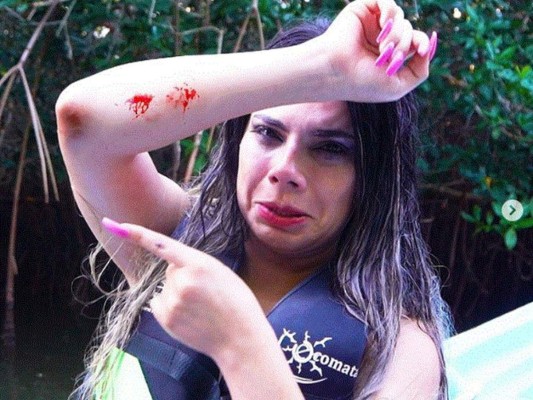 Lizbeth Rodríguez compartió esta imagen en su cuenta de Instagram donde muestra sus heridas tras el accidente.