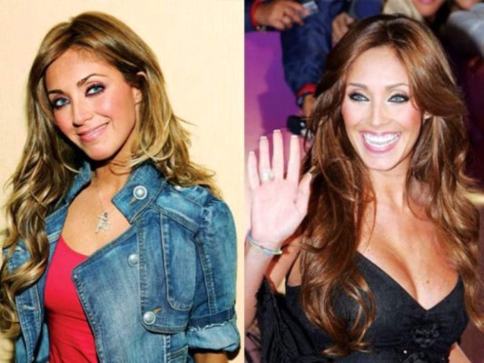 El antes y después de las bubis de las famosas