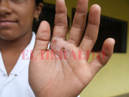 Lluvias aumentan las mordeduras de serpientes en oriente