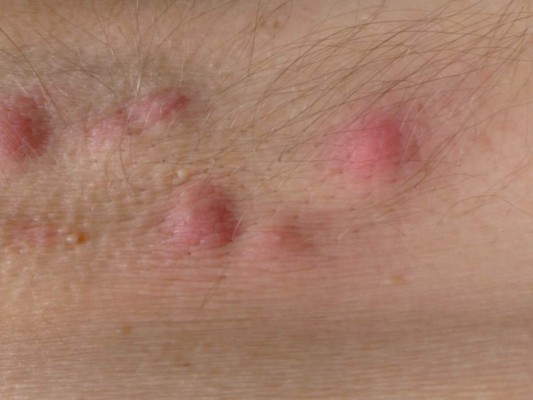 La hidradenitis son erupciones en la piel que afectan, en su mayoría, a las mujeres.