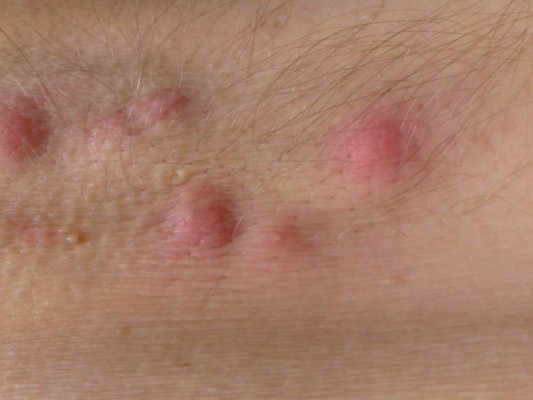 ¿Qué es la hidradenitis y cómo puede afectar tu relación íntima?