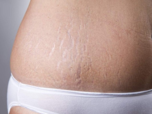 ¡Fácil y rápido! Elimina las estrías con estos tres remedios naturales