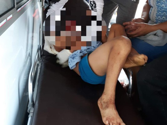 Seis niños y dos adultos quemados por pólvora en Honduras