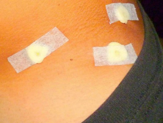 Elimina los lunares rojos de la piel con simples remedios caseros