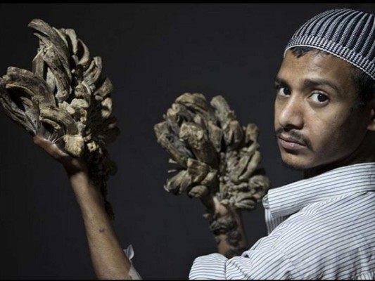 Así es Abul Bajandar, el 'hombre-árbol' bangladesí que pide ser amputado