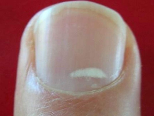 ¿Por qué aparecen manchas blancas en las uñas?