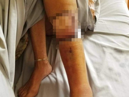 Muere mujer que se infectó con bacteria carnívora en una playa de Florida&nbsp; &nbsp;&nbsp;