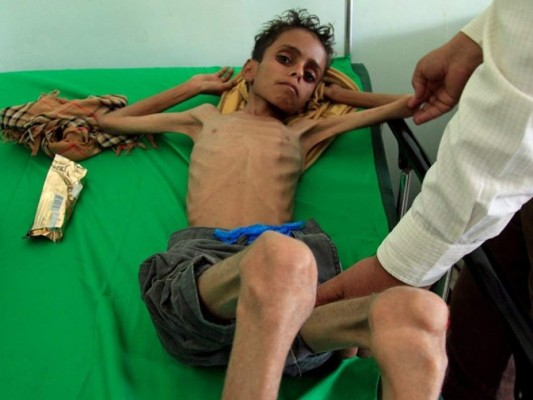 Ghazi Saleh, el rostro del hambre en Yemen