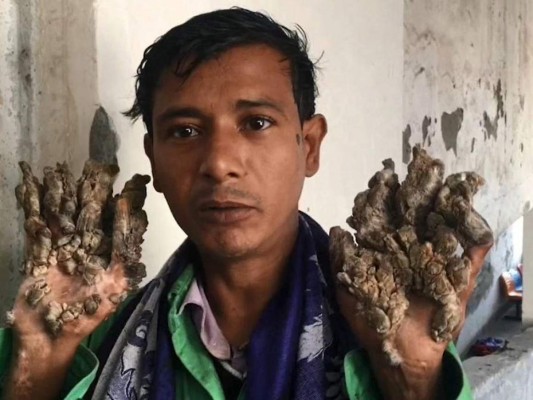 Así es Abul Bajandar, el 'hombre-árbol' bangladesí que pide ser amputado