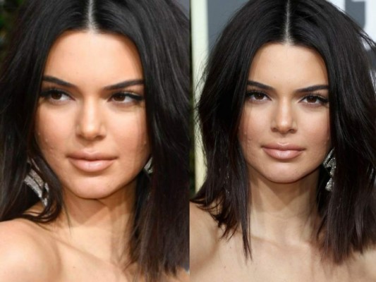 Critican severo acné de Kendall Jenner durante los Globos de Oro 2018 (FOTOS)