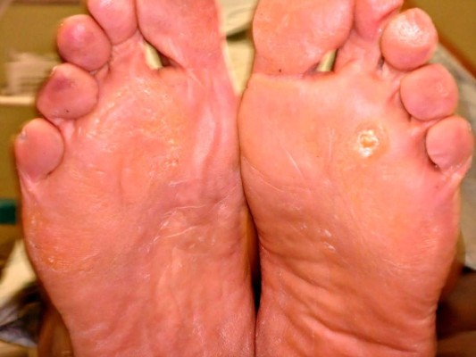 ¿Callos en los pies?