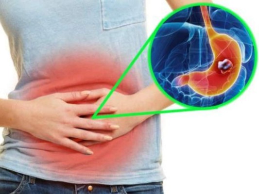 Cáncer de estómago: Los 10 síntomas que pueden detectar tempranamente la enfermedad