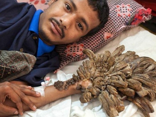 Así es Abul Bajandar, el 'hombre-árbol' bangladesí que pide ser amputado