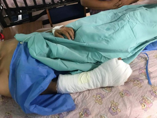 19 personas quemadas ingresaron al Hospital Escuela Universitario (HEU) por manipular pólvora en Navidad