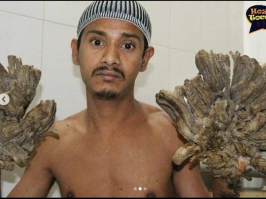 Así es Abul Bajandar, el 'hombre-árbol' bangladesí que pide ser amputado