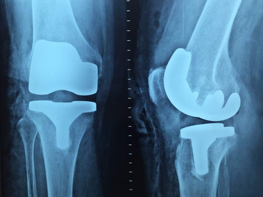 Crean nuevo sistema para disminuir el rechazo del cuepo humano hacia los implantes