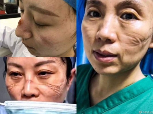 Impactantes fotos muestran estragos del coronavirus en personal médico