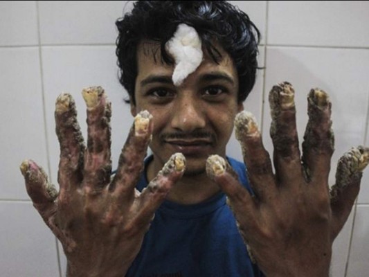 Así es Abul Bajandar, el 'hombre-árbol' bangladesí que pide ser amputado