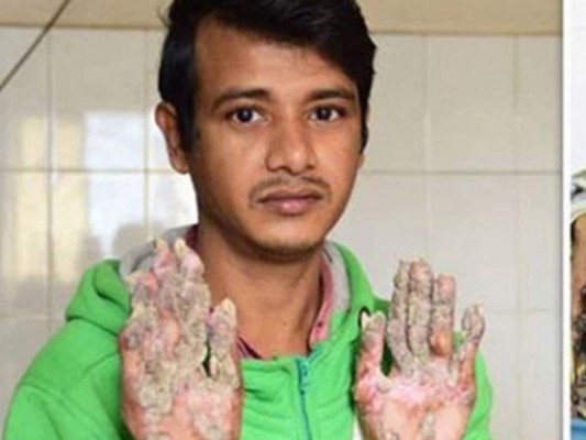 Así es Abul Bajandar, el 'hombre-árbol' bangladesí que pide ser amputado