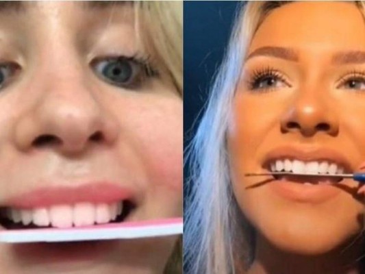 Conoce los riesgos de limarse los dientes con una lima