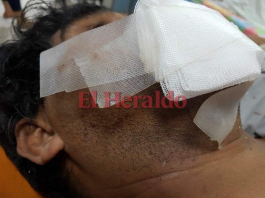 Tres personas resultan quemadas con pólvora en su vivienda en la colonia Nueva Capital