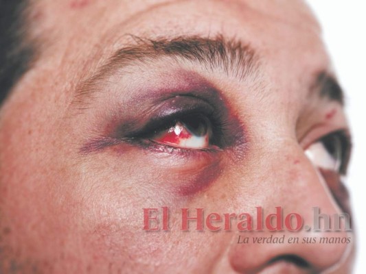 Salud adquirirá medicamentos en EEUU para pacientes con hongo negro