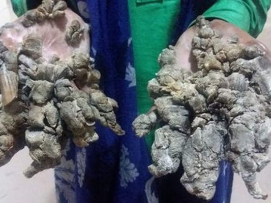 Así es Abul Bajandar, el 'hombre-árbol' bangladesí que pide ser amputado