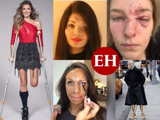 Modelos desfiguradas tras ser víctimas de crueles ataques y accidentes