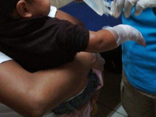 Niño resulta con quemaduras tras caerle agua hirviendo en la capital