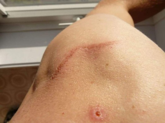 Remedios caseros para eliminar las cicatrices