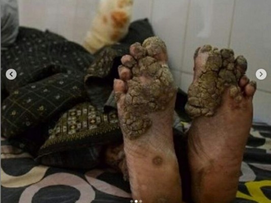 Así es Abul Bajandar, el 'hombre-árbol' bangladesí que pide ser amputado