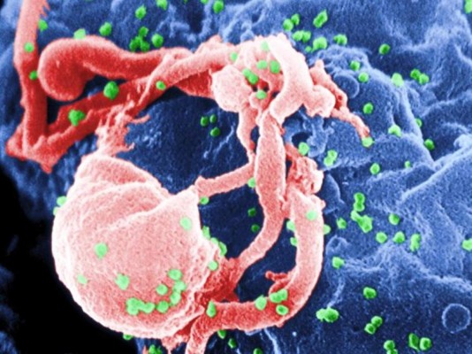 Identifican un caso único de transmisión de Sida entre mujeres