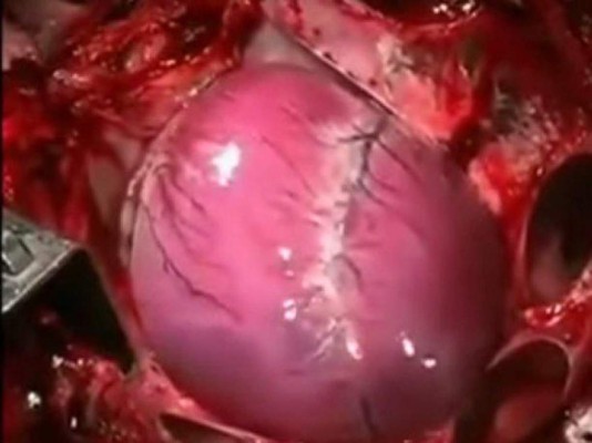 El corazón durante un infarto