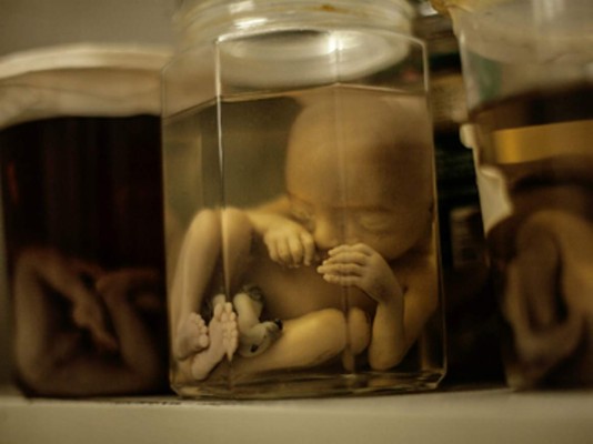 Zika podría causar más deficiencias además de microcefalia