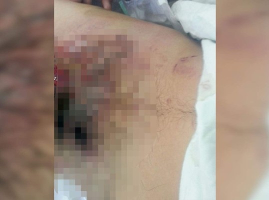 Reportan el primer quemado por pólvora en la capital de Honduras