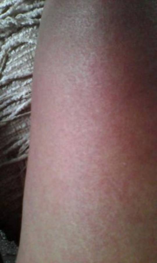 Honduras: Alarma por Chikungunya en la Villa de San Francisco