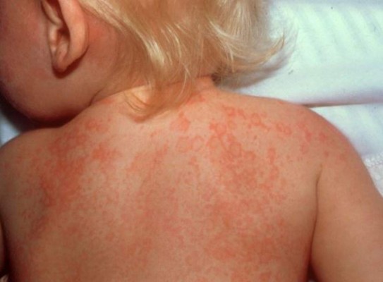 Hospital Escuela atendió niños afectados con Kawasaki en el 2017, este año no se han reportado casos