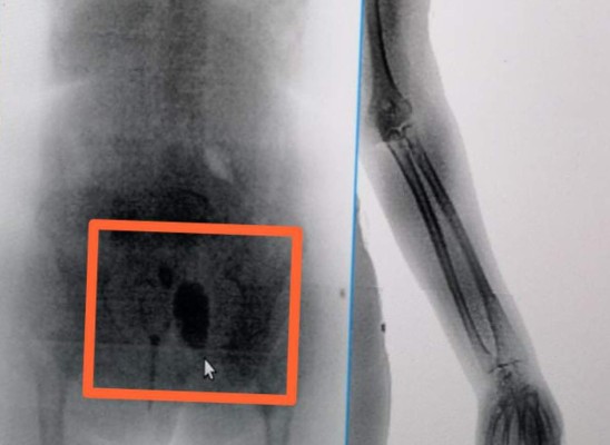 Detienen a mujer que llevaba droga oculta en su recto, para recluso de El Pozo I&nbsp;