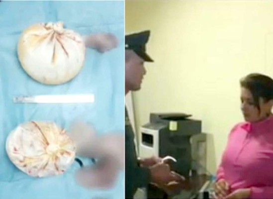 Cae hondureña con 'implantes' de droga en los senos