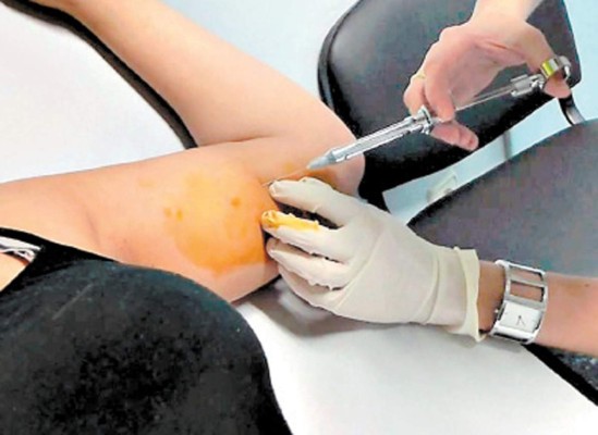 Implanon es como cualquier otro anticonceptivo